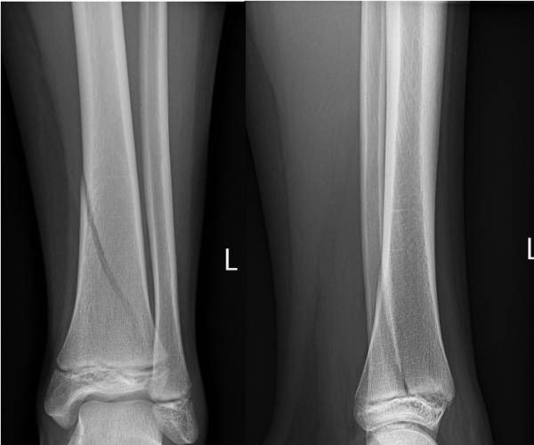 Fracture