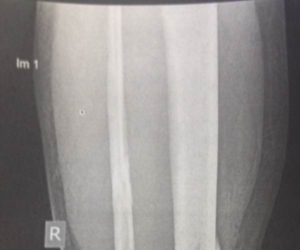 Fracture