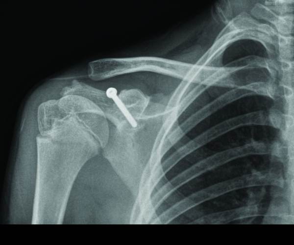 Fracture